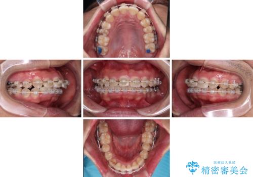 左右に顎がずれた咬み合わせ ワイヤー矯正で咬み合わせを改善の治療中