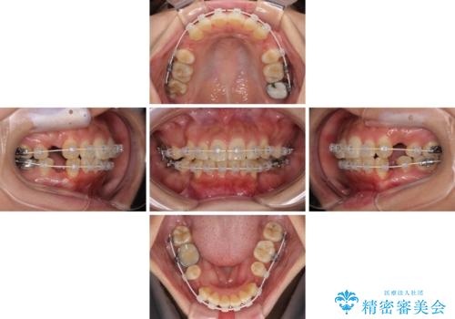 【モニター】唇が閉じにくい　ワイヤー装置での抜歯矯正の治療中