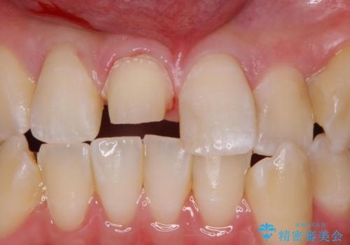 前歯の色が気になる。オールセラミッククラウンでのやり替えの治療中