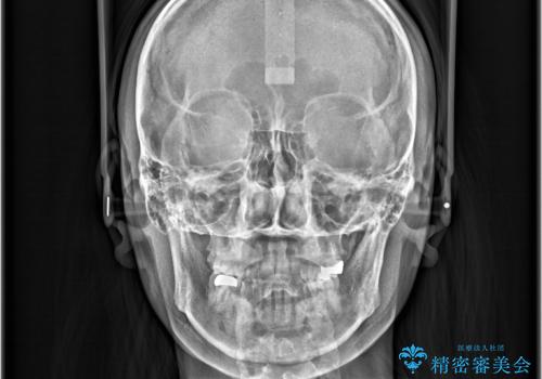 すきっ歯・切端咬合・空隙歯列|インビザラインで11ヵ月で治療完了の治療後