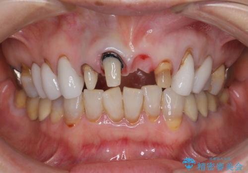 [ セラミック治療 ]  歯ぐきの際の黒ずみを改善したいの治療中