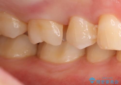 虫歯をしっかり治したい セラミックインレーの治療中