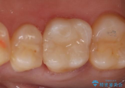 虫歯をしっかり治したい セラミックインレーの治療後