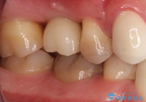 歯を入れたい インプラント+セラミッククラウンの治療後