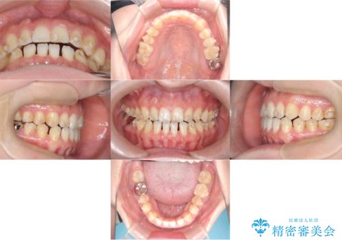 すきっ歯・切端咬合・空隙歯列|インビザラインで11ヵ月で治療完了の治療中