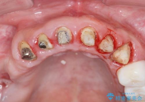 [ 歯周外科手術 ]  セラミック治療後の歯ぐきの違和感の治療中