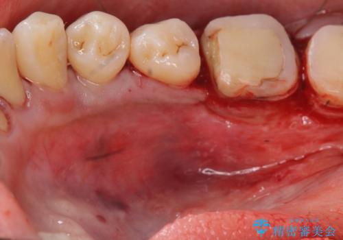 { 歯周外科 } 骨隆起除去を含む歯冠長延長術の治療中