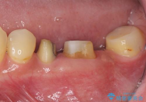 遊離歯肉移植術を併用した、破折歯のインプラント治療の症例 治療前