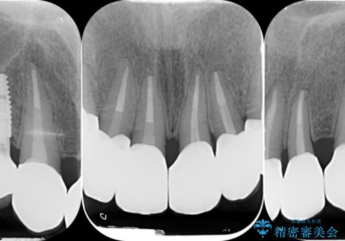 [ 歯周外科手術 ]  セラミック治療後の歯ぐきの違和感の治療後