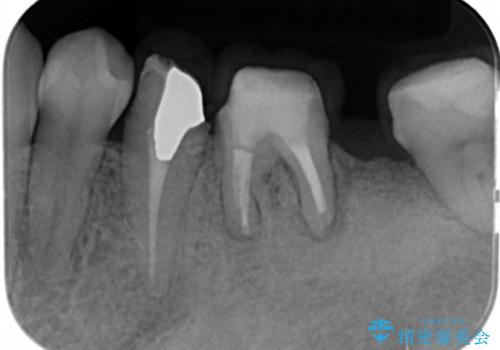 遊離歯肉移植術を併用した、破折歯のインプラント治療の治療前