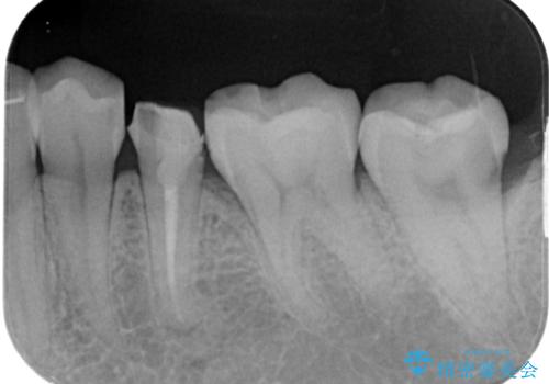被せものが割れた　オールセラミッククラウン・セラミックインレー修復の治療前