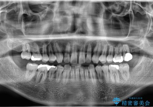 正中離開・クロスバイト・すきっ歯・叢生|インビザラインで治療の治療前