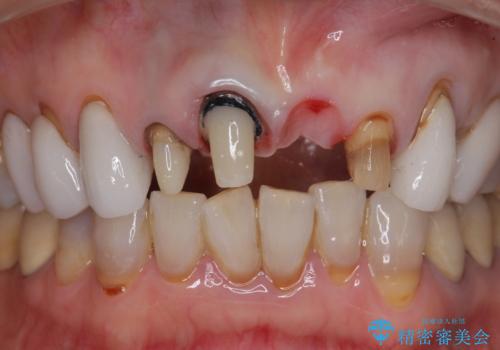 [ セラミック治療 ]  歯ぐきの際の黒ずみを改善したいの治療中