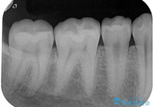 奥歯の治療をしたい　セラミックインレーの治療後