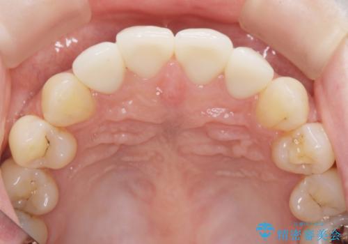 前歯の劣化したコンポジットレジン修復をセラミッククラウンへの治療後