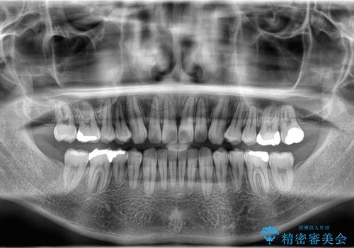 正中離開・クロスバイト・すきっ歯・叢生|インビザラインで治療の治療後