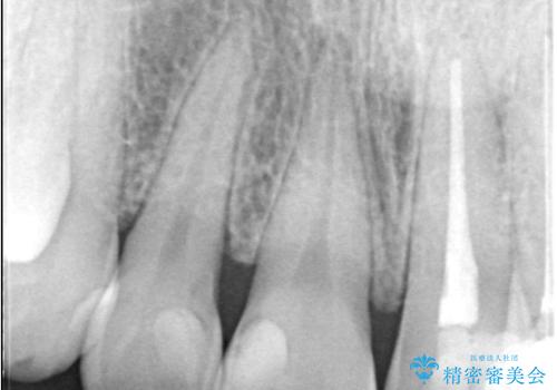 欠けて変色した前歯を一新!オールセラミックで叶える自然な笑顔の治療前