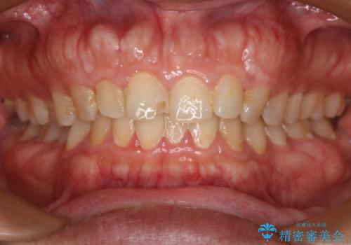 前歯が欠けたので綺麗にしたい　オールセラミッククラウンの症例 治療前