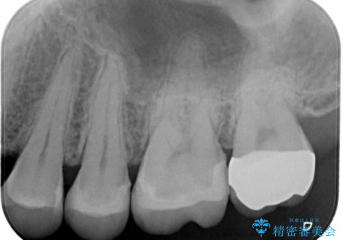 【メタルフリー】銀歯を綺麗な白い歯にの治療後