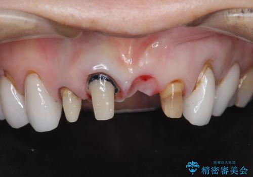 [ セラミック治療 ]  歯ぐきの際の黒ずみを改善したいの治療中