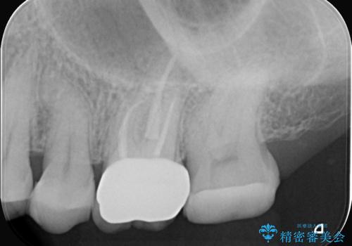 奥歯の痛みを根本から解消し、クラウンで歯の強度を回復の治療後