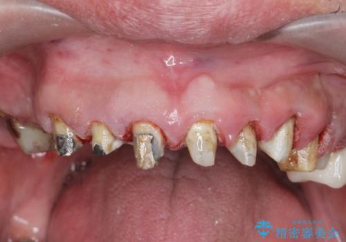 [ 歯周外科手術 ]  セラミック治療後の歯ぐきの違和感の治療前
