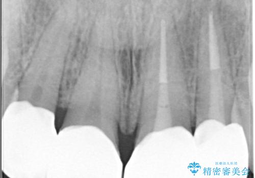 欠けて変色した前歯を一新!オールセラミックで叶える自然な笑顔の治療後