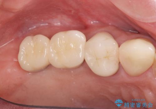 奥歯でしっかりと咬みたい　咬合機能をしっかりと回復するインプラント治療の治療後