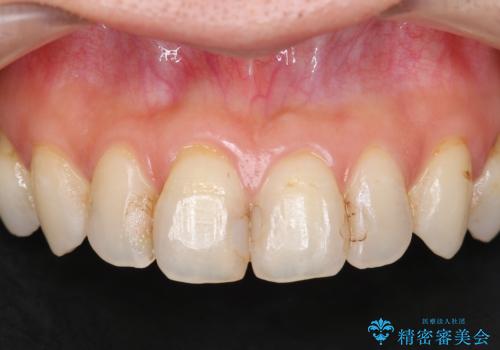 前歯の劣化したコンポジットレジン修復をセラミッククラウンへの症例 治療前