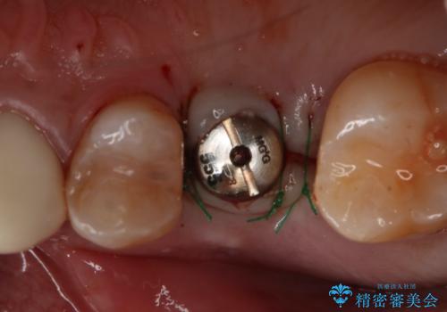 歯を入れたい インプラント+セラミッククラウンの治療中