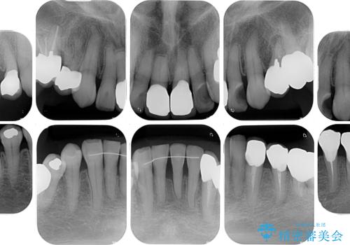 長年気になっていた前歯 矯正治療と補綴治療による審美歯科治療の治療後