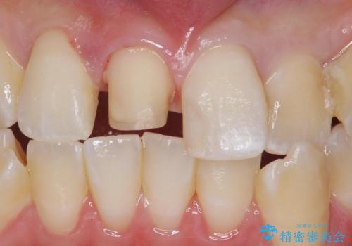 前歯の色が気になる。オールセラミッククラウンでのやり替えの治療中