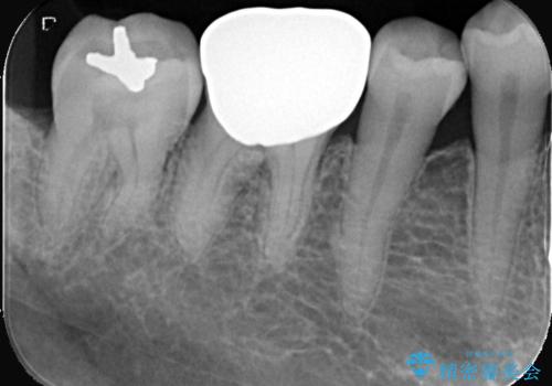 銀歯を白くしたい!|オールセラミッククラウンで審美回復の治療前