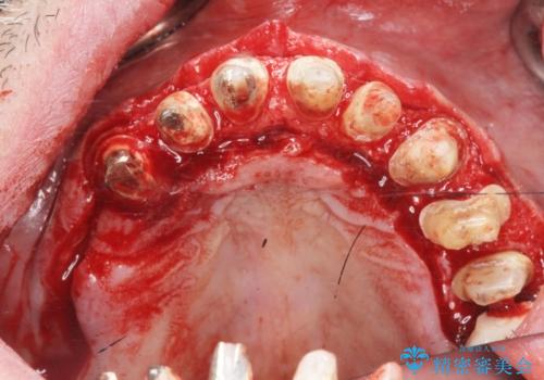 [ 歯周外科手術 ]  セラミック治療後の歯ぐきの違和感の治療中