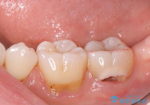 【セラミッククラウン】【生活歯髄療法】歯に穴が空いている