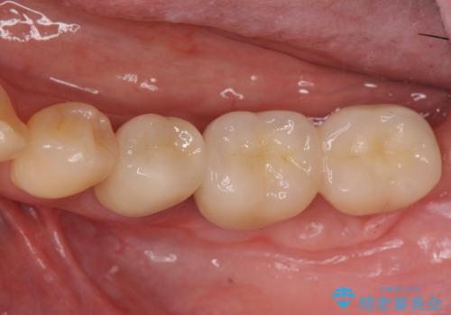 遊離歯肉移植術を併用した、破折歯のインプラント治療の治療後