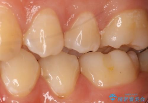 虫歯を治療したい セラミックインレーの治療前