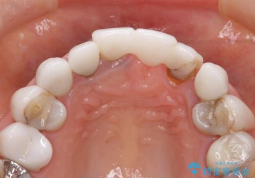 [ セラミック治療 ]  歯ぐきの際の黒ずみを改善したいの治療前