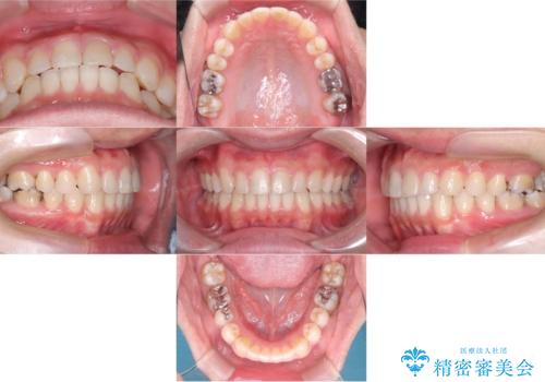 正中離開・クロスバイト・すきっ歯・叢生|インビザラインで治療の治療後