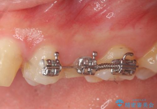 歯の水平・垂直的位置を整備したセラミッククラウン治療の治療中