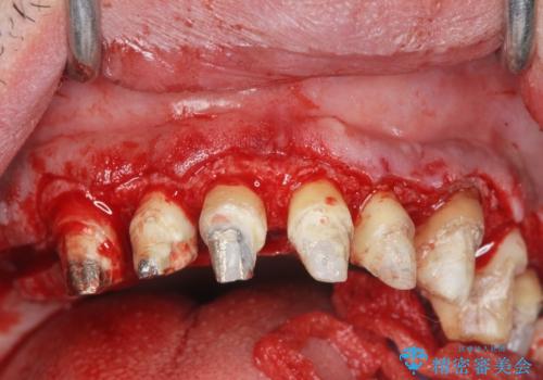 [ 歯周外科手術 ]  セラミック治療後の歯ぐきの違和感の治療中