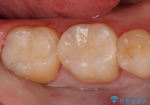奥歯の治療をしたい　セラミックインレー