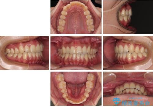 矯正後の後戻りをインビザラインライトで再治療|目立たない矯正の症例紹介の治療前