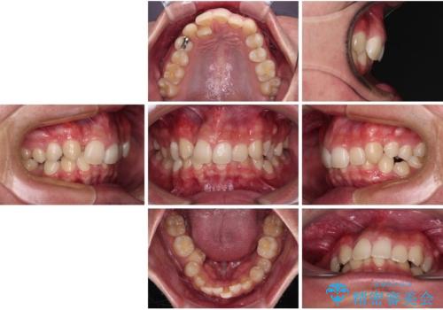 抜歯矯正で叢生と正中のずれを改善|審美装置による矯正症例の治療前