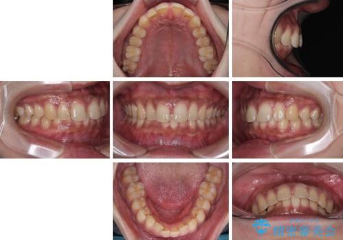 目立たない矯正で正中離開と下の前歯のデコボコを改善|インビザラインによる治療症例の治療前