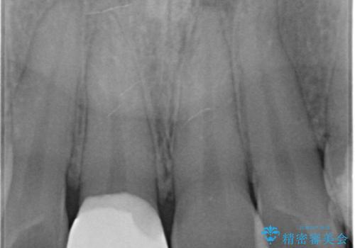 前歯の色が気になる。オールセラミッククラウンでのやり替えの治療前