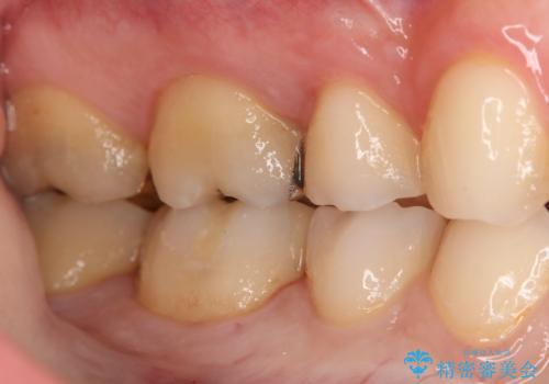 奥歯の治療をしたい　セラミックインレーの治療後