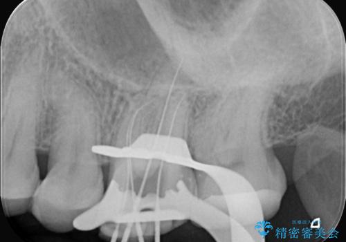 奥歯の痛みを根本から解消し、クラウンで歯の強度を回復