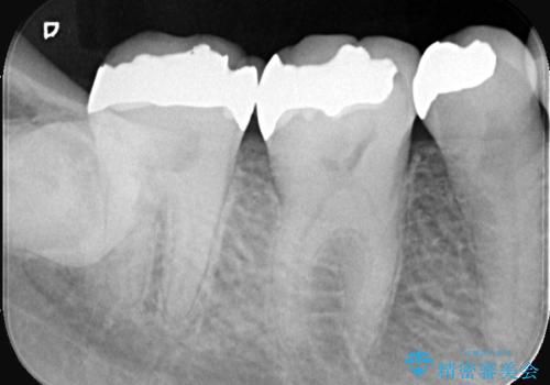 欠けた奥歯の強度を向上!PGAクラウンで安心の咬み心地を再建の治療前