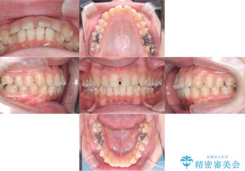 正中離開・クロスバイト・すきっ歯・叢生|インビザラインで治療の治療前